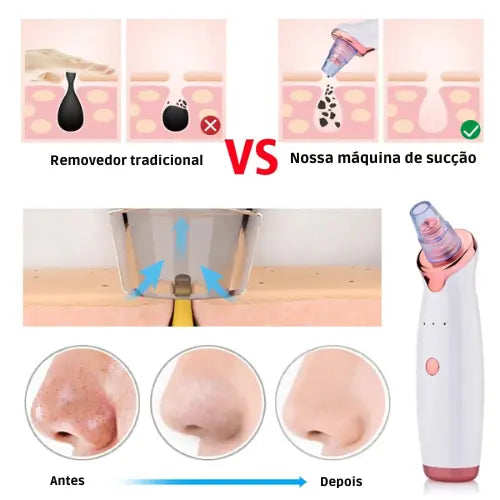 Aparelho Para Limpeza Facial – 6 Benefícios em 1